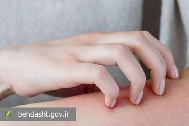 تغییر فصل، محرک اگزما نه عامل ایجاد آن